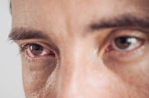 Urgent Eye Care ues red eyes 300x197 1